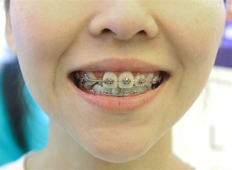 how to make real braces.